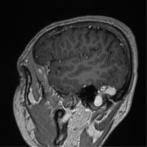 Cerebral venous thrombosis (Radiopaedia 38392-40469 Sagittal T1 C+ 20).png