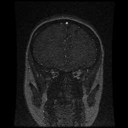 Cerebral venous thrombosis - ulcerative colitis (Radiopaedia 66049-75219 Coronal MRV 87).jpg