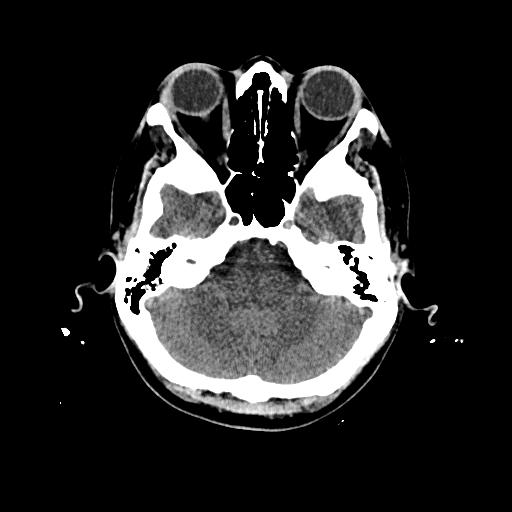 Cerebral venous thrombosis with venous hemorrhagic infarct (Radiopaedia 90354-107660 Axial non-contrast 13).jpg
