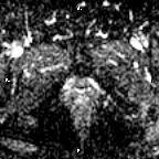 File:Cervical adenocarcinoma (Radiopaedia 65011-73985 Axial ADC 4).jpg