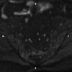 Cervical adenocarcinoma (Radiopaedia 65011-73985 Axial DWI 83).jpg