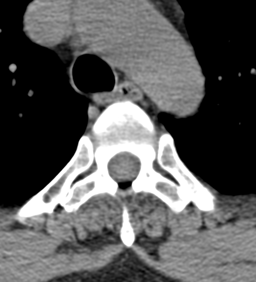 File:Cervical canal stenosis - OPLL and osteophytes (Radiopaedia 47329-51910 Axial non-contrast 73).png