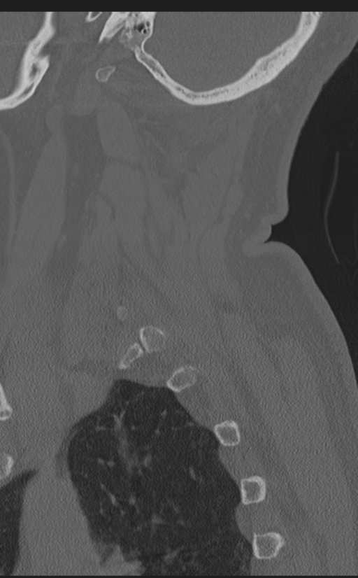 Cervical canal stenosis due to ossification of the posterior longitudinal ligament (Radiopaedia 47260-51823 Sagittal bone window 65).png