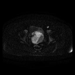 File:Cervical carcinoma (Radiopaedia 67644-77047 Axial DWI 14).jpg