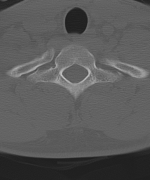 Cervical intercalary bone (Radiopaedia 35211-36748 Axial bone window 56).png