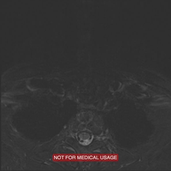 Cervical nerve schwannoma (Radiopaedia 27964-28221 C 48).jpg
