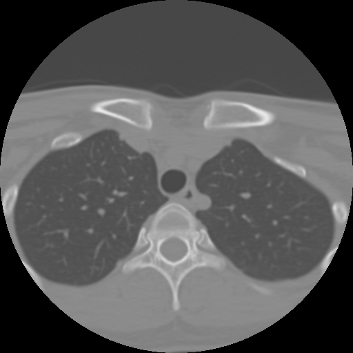 Cervical rib (Radiopaedia 71110-81363 Axial non-contrast 59).jpg