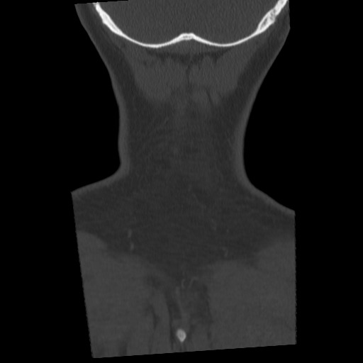 Cervical schwannoma (Radiopaedia 57979-64974 Coronal bone window 56).png
