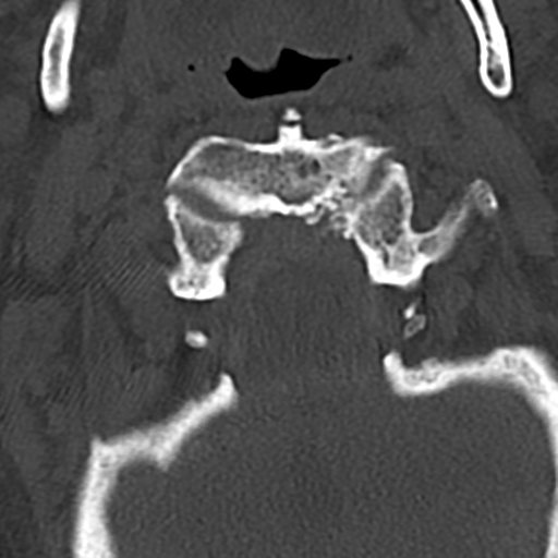 File:Cervical spine fracture - chalk stick (Radiopaedia 39116-41323 Axial bone window 18).png
