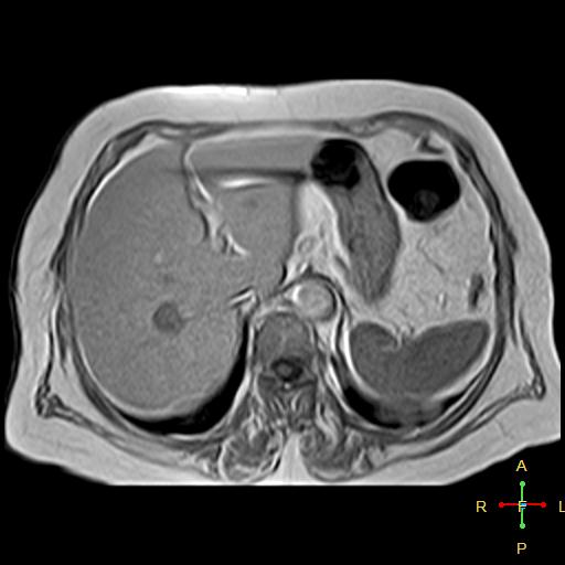 File:Cervical stump squamous cell carcinoma (Radiopaedia 48049-52858 H 12).jpg