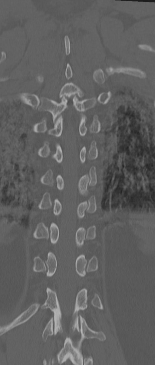 Chance fracture (Radiopaedia 33854-35020 Coronal bone window 63).png