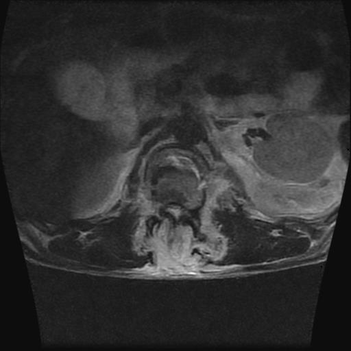 File:Chance type fracture (Radiopaedia 31020-31725 Axial T2 11).jpg