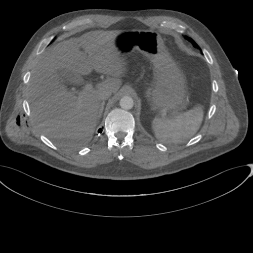 File:Chest multitrauma - aortic injury (Radiopaedia 34708-36147 A 280).png