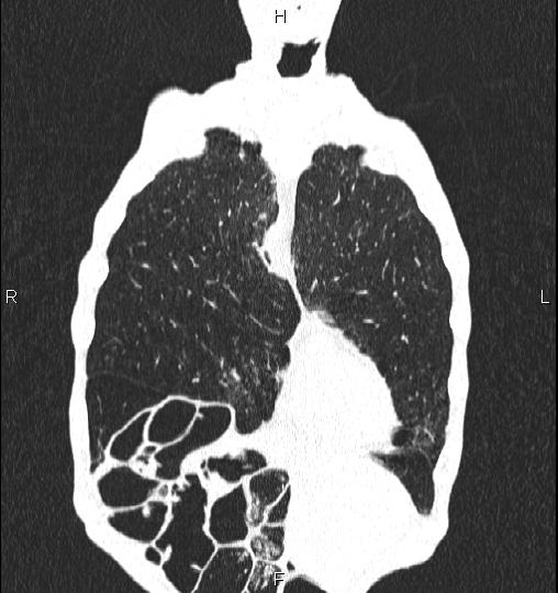 Chilaiditi sign (Radiopaedia 88839-105611 Coronal lung window 12).jpg