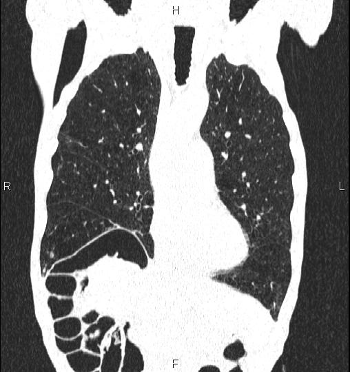 Chilaiditi sign (Radiopaedia 88839-105611 Coronal lung window 23).jpg