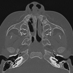 File:Choanal atresia (Radiopaedia 88525-105975 Axial bone window 24).jpg