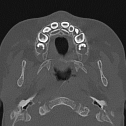 File:Choanal atresia (Radiopaedia 88525-105975 Axial bone window 3).jpg