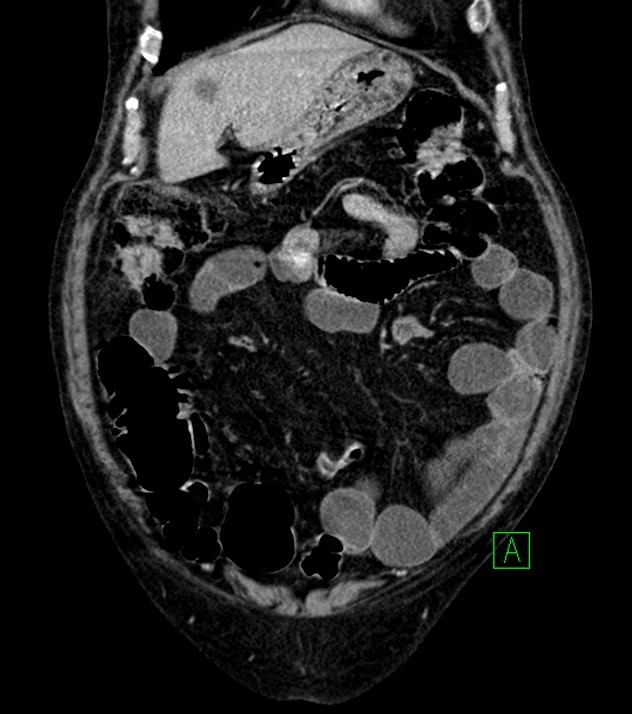 Cholangiocarcinoma with cerebral metastases (Radiopaedia 83519-98629 G 20).jpg