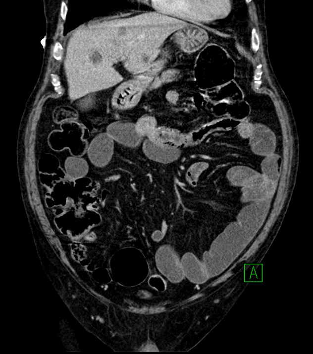 Cholangiocarcinoma with cerebral metastases (Radiopaedia 83519-98629 G 25).jpg