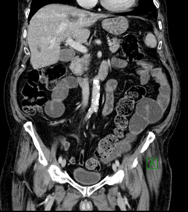Cholangiocarcinoma with cerebral metastases (Radiopaedia 83519-98629 G 38).jpg