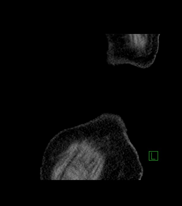 Cholangiocarcinoma with cerebral metastases (Radiopaedia 83519-98629 Sagittal C+ delayed 109).jpg