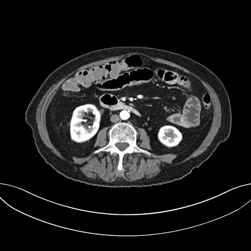 File:Cholecystoduodenal fistula due to calculous cholecystitis with gallstone migration (Radiopaedia 86875-103077 A 37).jpg