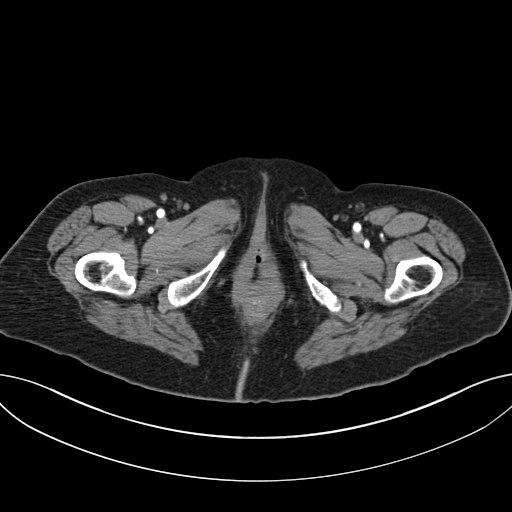 Cholecystoduodenal fistula due to calculous cholecystitis with gallstone migration (Radiopaedia 86875-103077 A 81).jpg