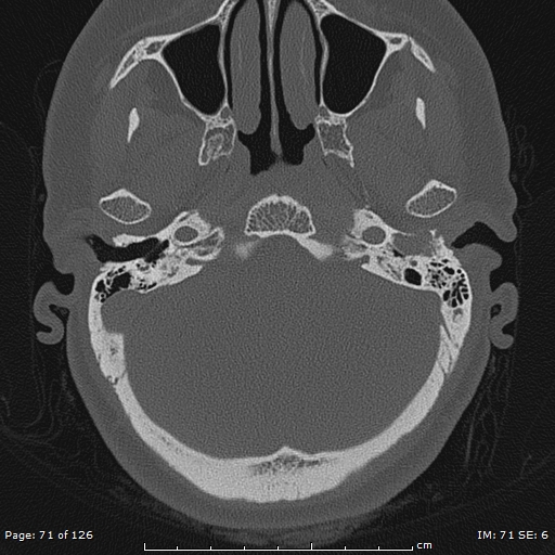 Cholesteatoma - external auditory canal (Radiopaedia 88452-105096 Axial bone window 34).jpg