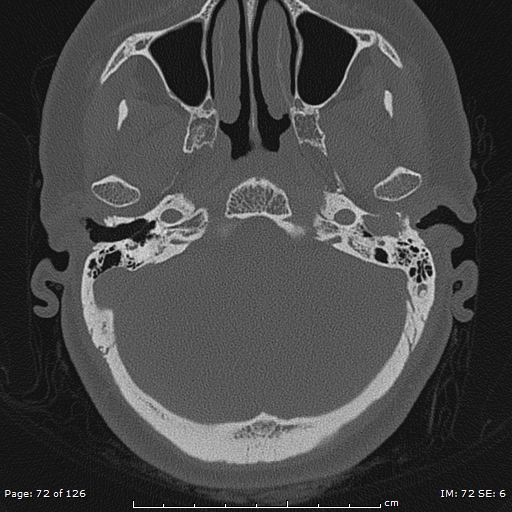 Cholesteatoma - external auditory canal (Radiopaedia 88452-105096 Axial bone window 35).jpg