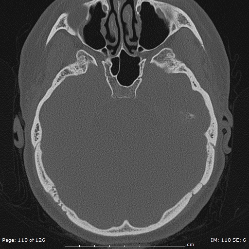Cholesteatoma - external auditory canal (Radiopaedia 88452-105096 Axial bone window 73).jpg