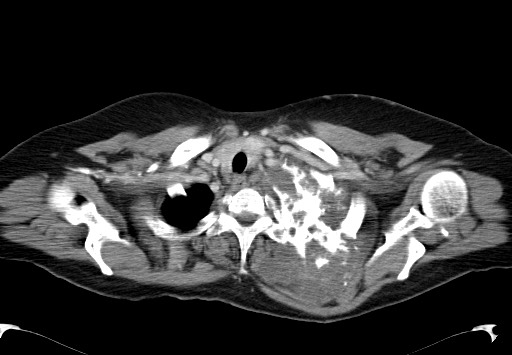 File:Chondrosarcoma - chest wall (Radiopaedia 65192-74199 C 7).jpg