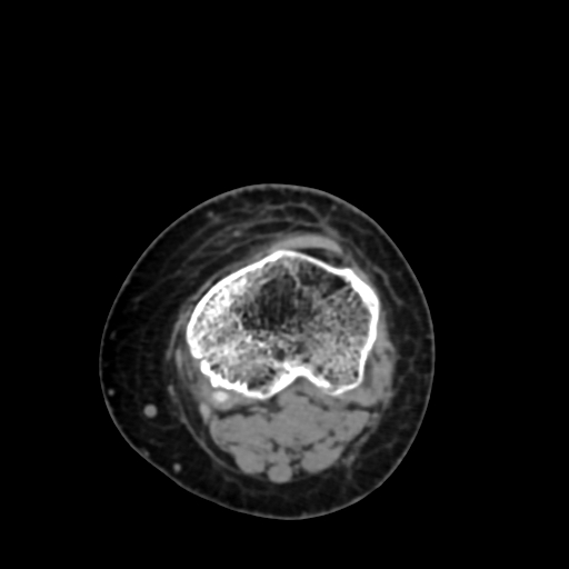 File:Chondrosarcoma - femur (Radiopaedia 64187-72954 Axial non-contrast 66).jpg
