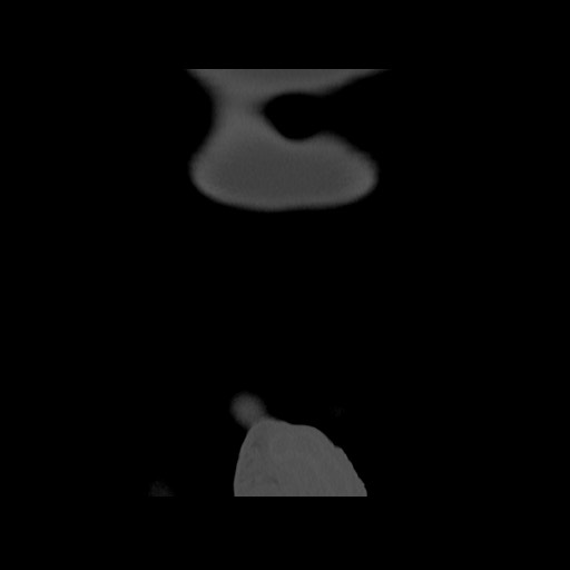 Chondrosarcoma of iliac wing (Radiopaedia 63861-72599 Coronal bone window 11).jpg