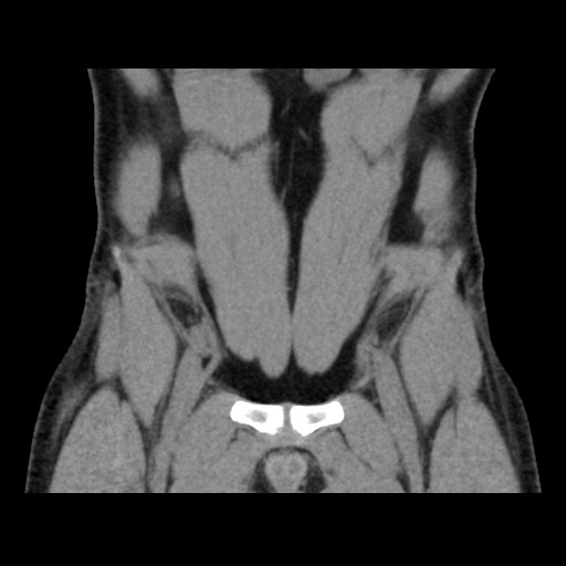Chondrosarcoma of iliac wing (Radiopaedia 63861-72599 Coronal non-contrast 29).jpg