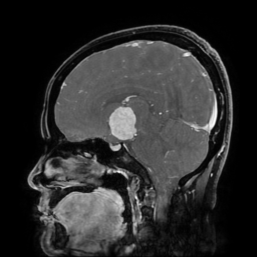 File:Chordoid glioma of third ventricle (Radiopaedia 91612-109340 F 101).jpg