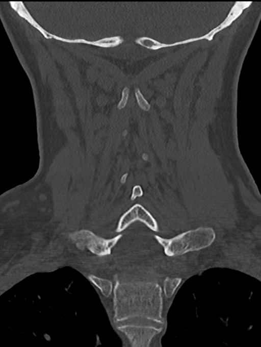 Chordoma (C4 vertebra) (Radiopaedia 47561-52188 Coronal bone window 40).png