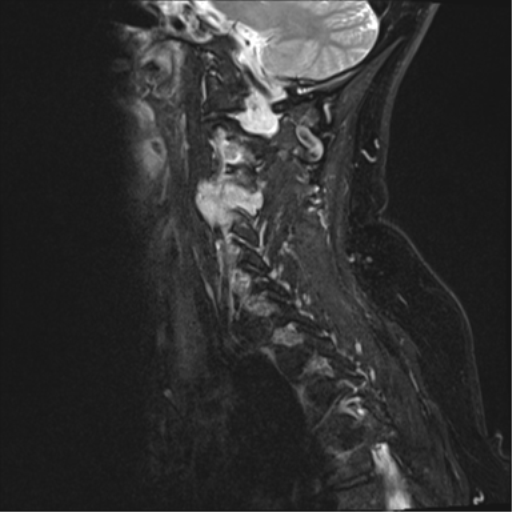 File:Chordoma (C4 vertebra) (Radiopaedia 47561-52189 Sagittal T2 fat sat 11).png
