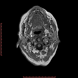 File:Choroid plexus xanthogranuloma (Radiopaedia 67843-77270 Axial T1 159).jpg