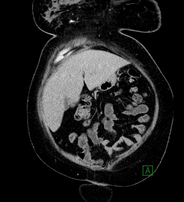 Chromophobe renal cell carcinoma (Radiopaedia 84239-99519 F 19).jpg