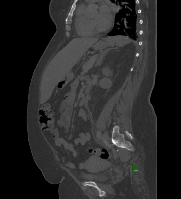 Chromophobe renal cell carcinoma (Radiopaedia 84239-99519 Sagittal bone window 44).jpg