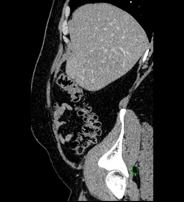 Chromophobe renal cell carcinoma (Radiopaedia 84286-99573 I 152).jpg