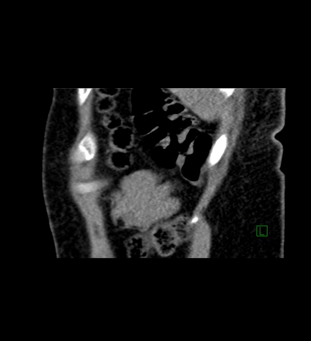 Chromophobe renal cell carcinoma (Radiopaedia 84290-99582 D 8).jpg