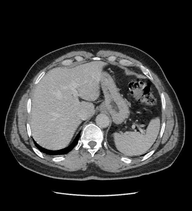 Chromophobe renal cell carcinoma (Radiopaedia 86879-103083 C 24).jpg