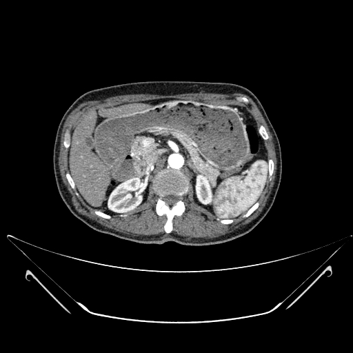 File:Chronic contained rupture of abdominal aortic aneurysm with extensive erosion of the vertebral bodies (Radiopaedia 55450-61901 A 12).jpg