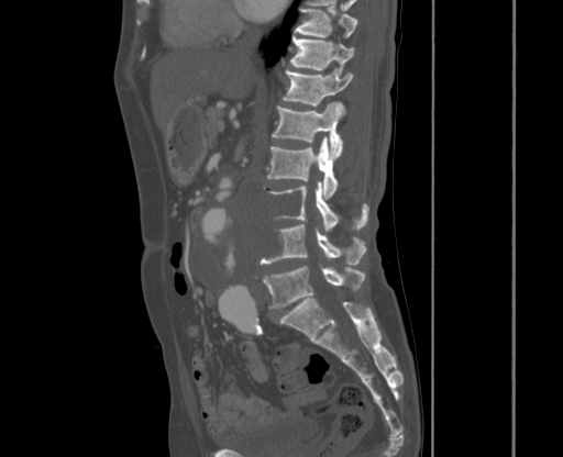 File:Chronic contained rupture of abdominal aortic aneurysm with extensive erosion of the vertebral bodies (Radiopaedia 55450-61901 Sagittal bone window 14).jpg