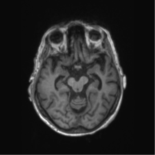 File:Chronic hypertensive encephalopathy (Radiopaedia 72844-83495 Axial T1 45).png