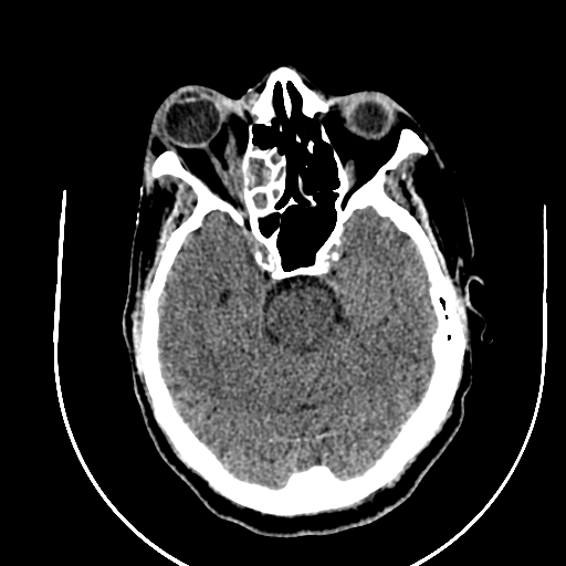 Chronic invasive fungal sinusitis (Radiopaedia 91563-109286 Axial non-contrast 33).jpg