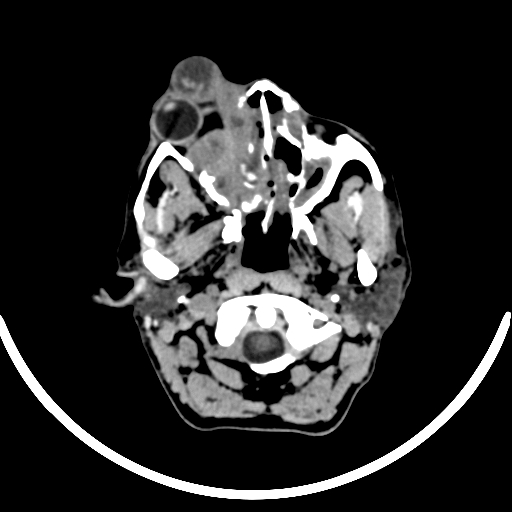 File:Chronic invasive fungal sinusitis with intraorbital and intracranial extension (Radiopaedia 56387-63046 Axial non-contrast 80).jpg