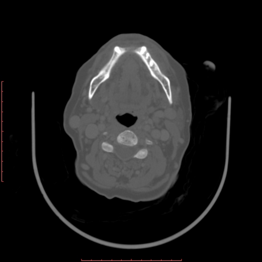 Chronic osteomyelitis - maxilla (Radiopaedia 23783-23927 Axial bone window 32).jpg