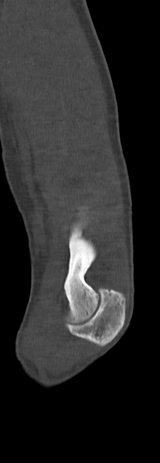 Chronic osteomyelitis of the distal humerus (Radiopaedia 78351-90971 Sagittal bone window 58).jpg
